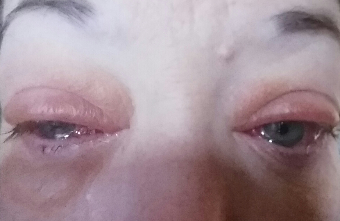 flu-season-is-also-pink-eye-season-west-georgia-eyecare