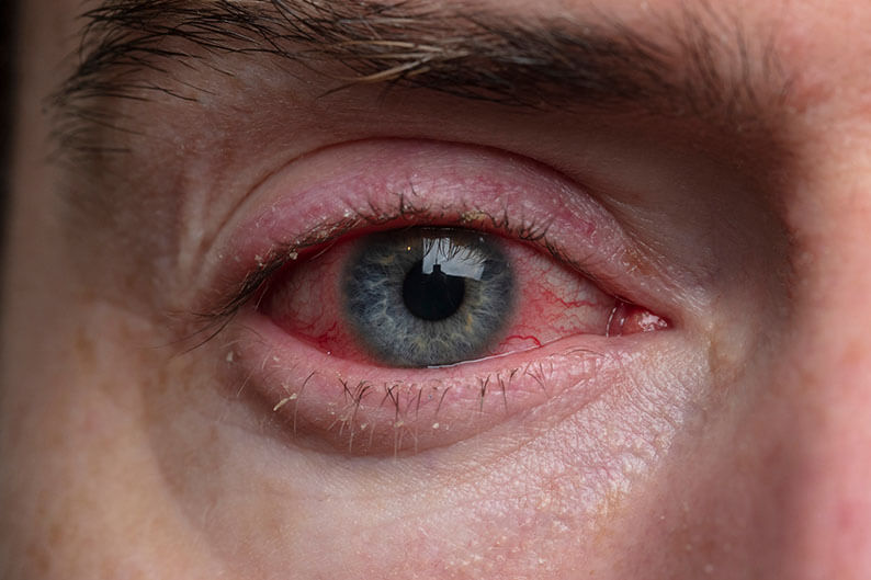 Closeup of an Eye With Blepharitis