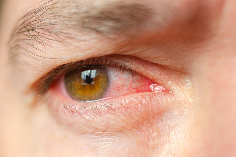 Closeup of an Eye With Conjunctivitis