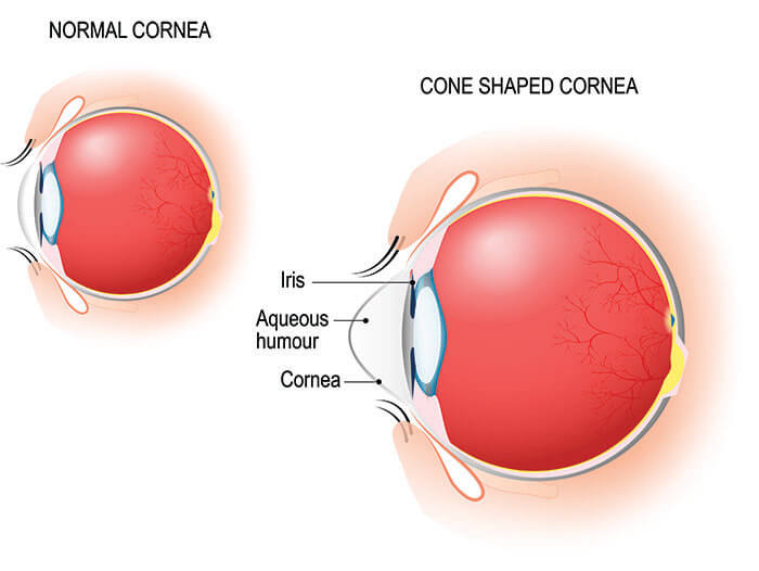 Chart Illustrating Keratoconus in an Eye